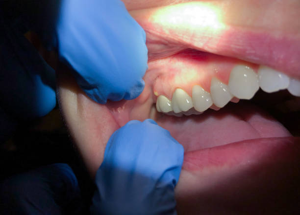 Best Emergency Dental Care for Broken or Chipped Teeth in Franklin Grove, IL