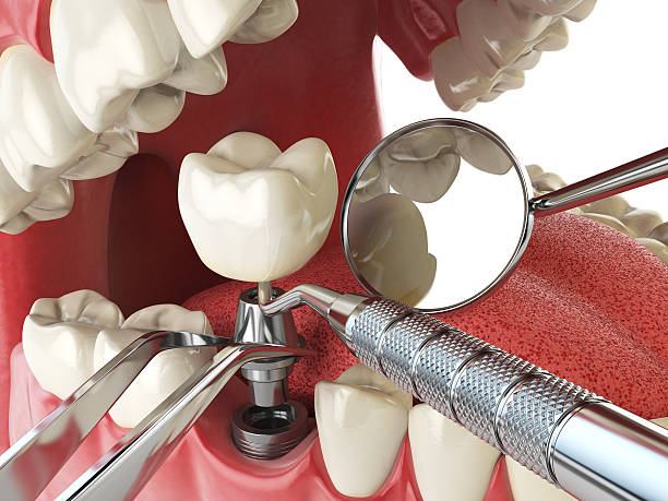 Best Emergency Wisdom Teeth Removal in Franklin Grove, IL